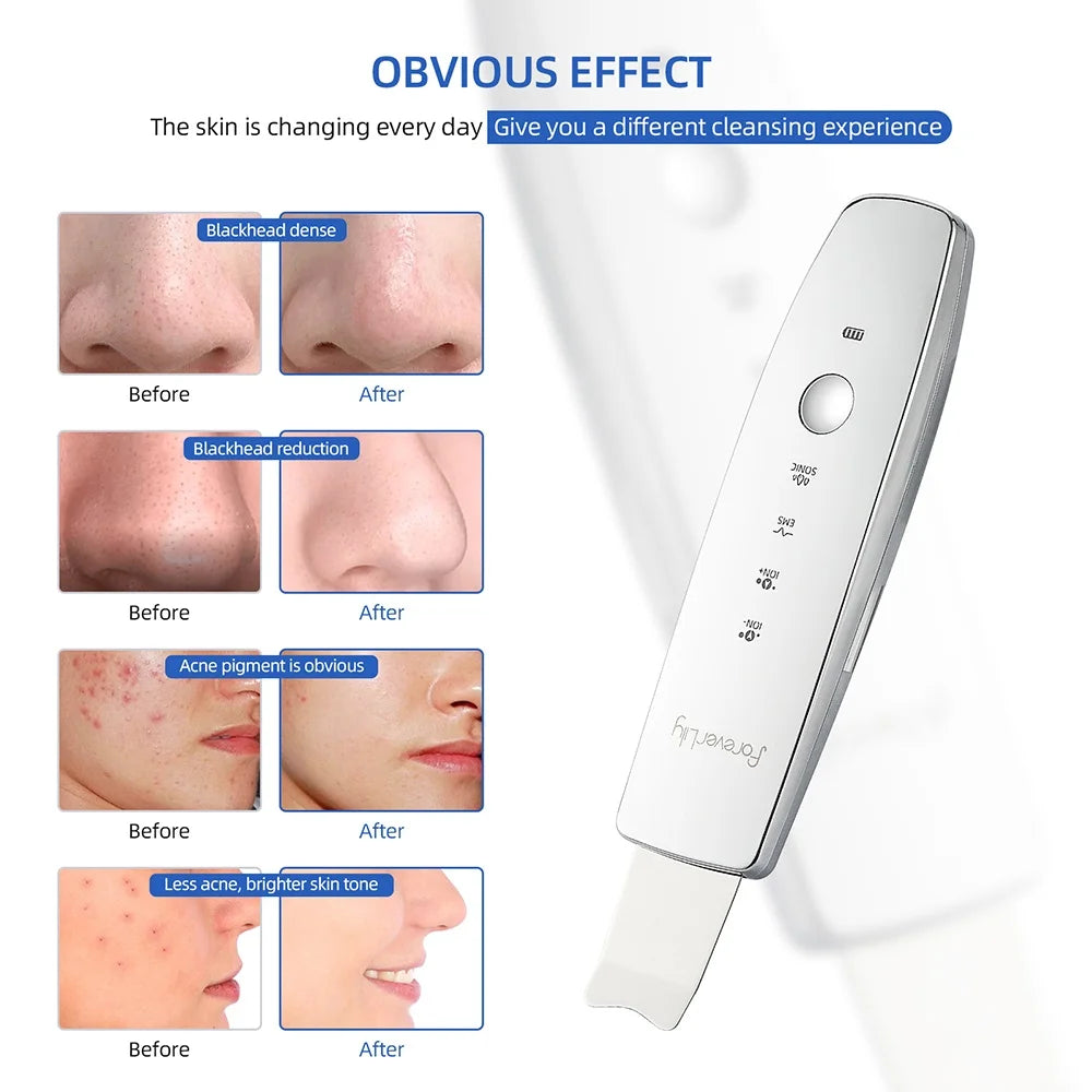 Why?  Professional Skin Care For You!  6 in 1 EMS Ultrasonic Skin Scrubber ION LED Photon Lifting Massager Spatula Blackhead Remover Facial Deep Cleansing